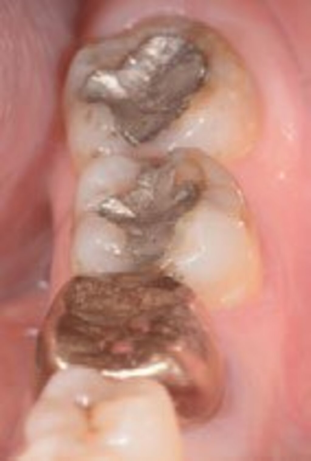 Zähne mit Metall