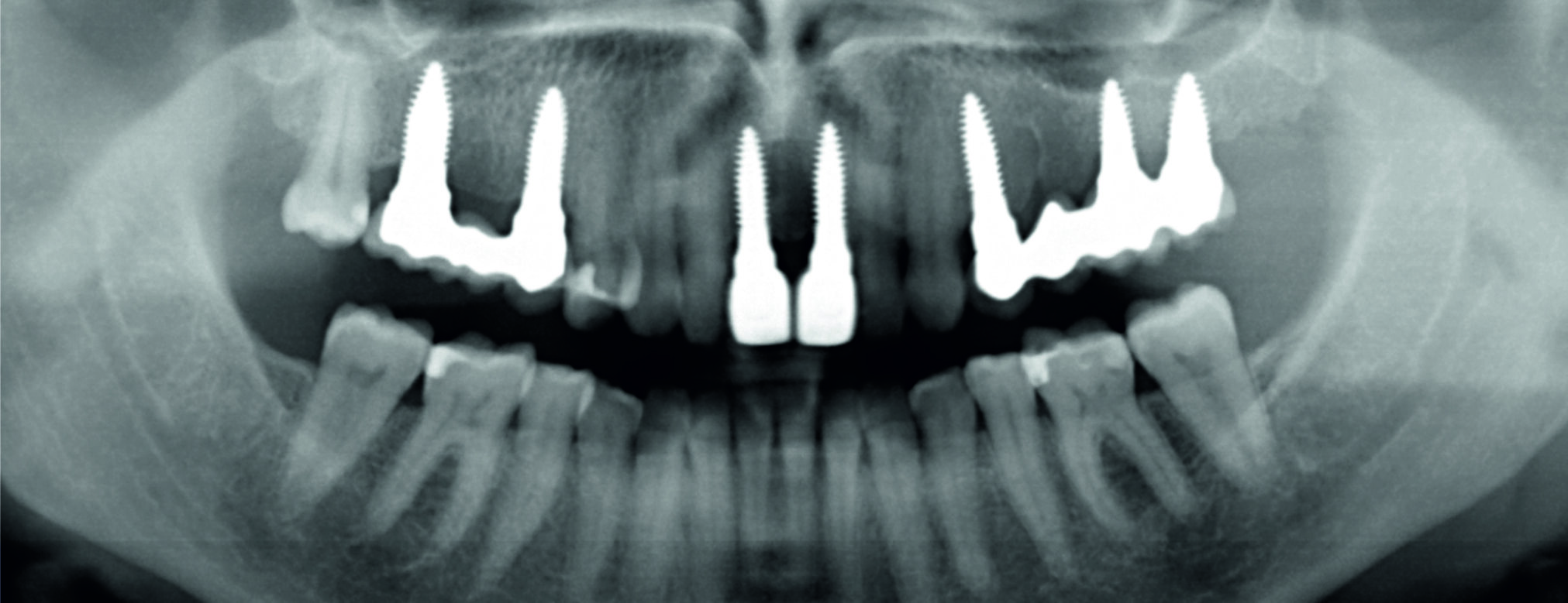 Panoramaschichtaufnahme Keramikimplantate