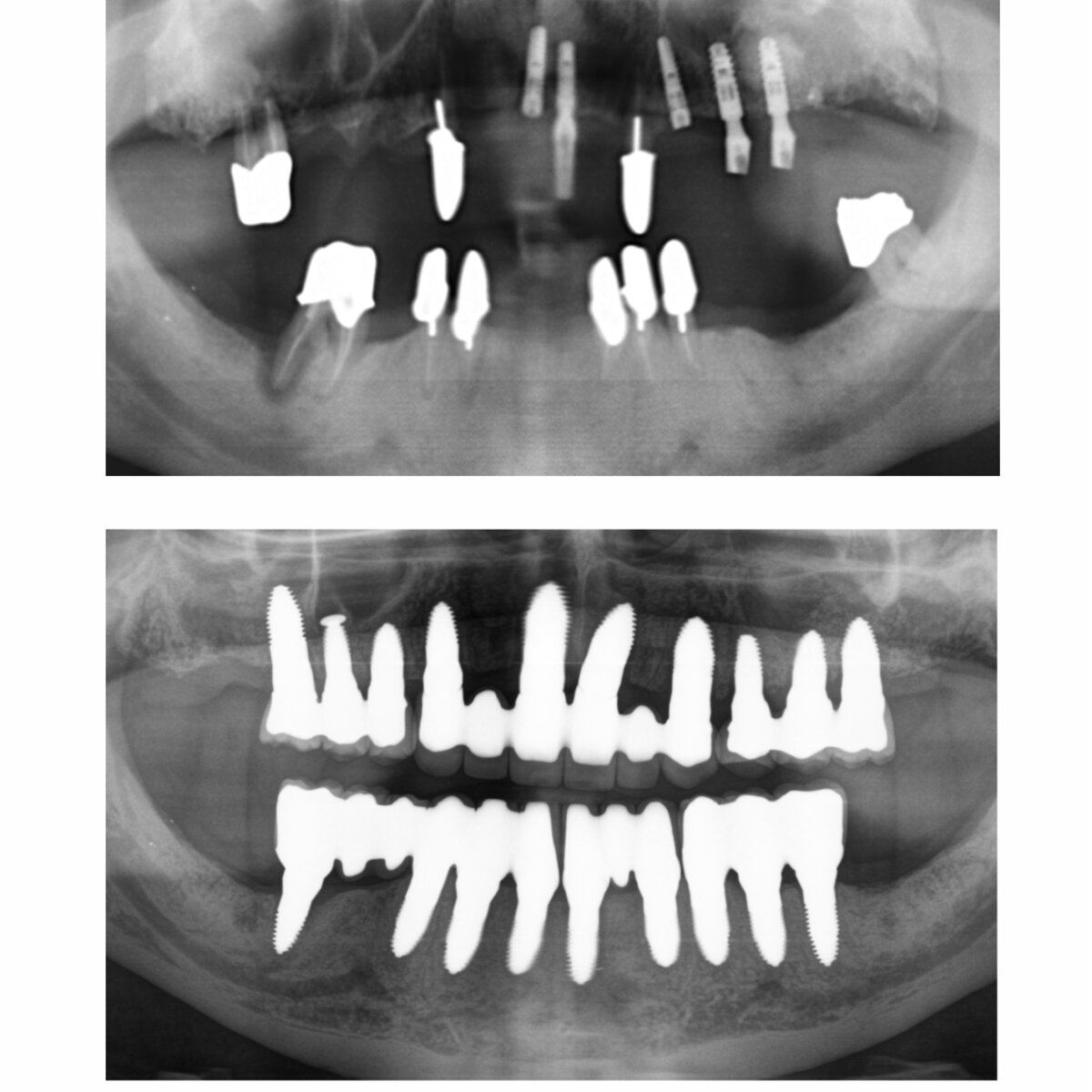 Keramikimplantate