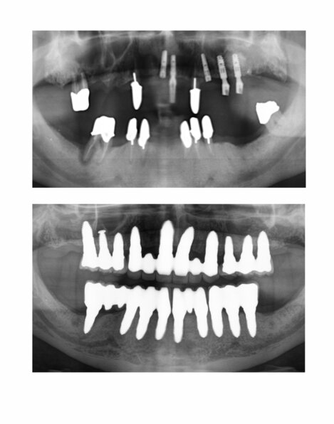 Keramikimplantate